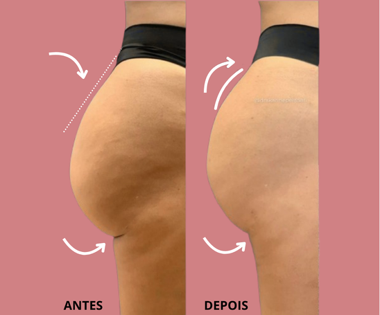 Bioestimuladores de Colágeno