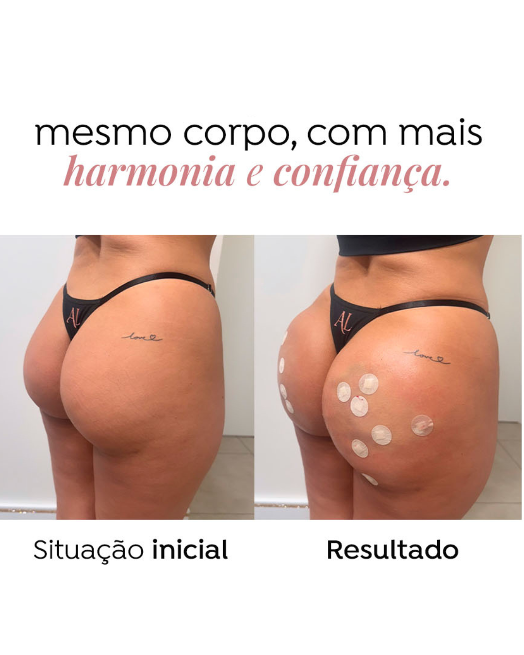 Harmonização Glútea